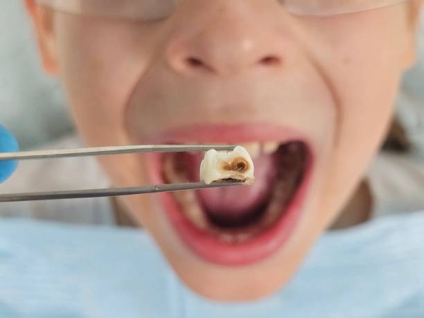 Best Emergency Dental Care for Abscessed Tooth in Whitewater, CA
